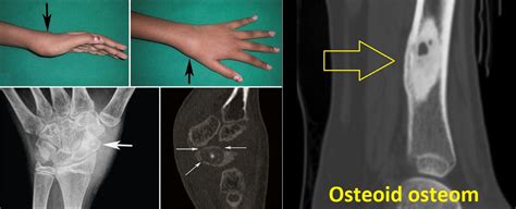 Osteoid Osteom Příznaky Projevy Symptomy Příčina Léčba