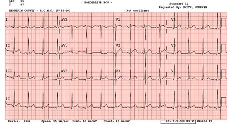 L'ecg può mostrare un diffuso sopraslivellamento del tratto st. Dr. Smith's ECG Blog: 24 yo woman with chest pain: Is this ...