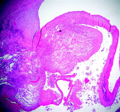 Organized Granulation Tissue Mimicking Left Atrial Myxoma Recurrence