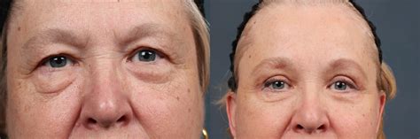 Eyelid Surgery Before And After Photos Patient 584 Louisville