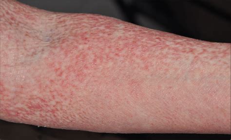 Pruritic Scaly Rash On Arms And Legs —quiz Case Dermatology Jama