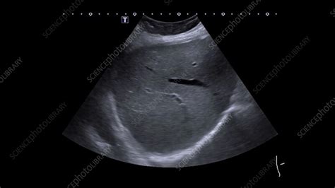 Healthy Liver Ultrasound Scan Stock Video Clip K0112176 Science