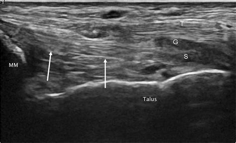 Ankle And Midfoot Ligaments Ultrasound With Anatomical Correlation A Review European Journal