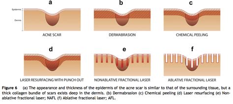 Beautiful Results Of Treatment Of Acne Scars Using Fractionated Co2 Lasers