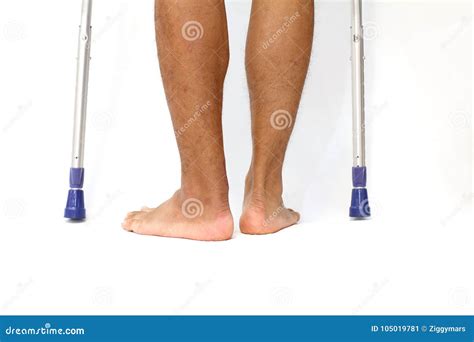 Operation Scar Of Achilles Tendon Rupture And Crutchs Stock Image