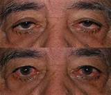 Photos of Insurance Cover Eyelid Surgery