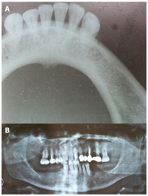 Chronic Sclerosing Sialadenitis Of The Sublingual Gland Case Report