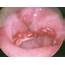 Bi Lobed Zenkers Diverticulum  Signs And Symptoms Of Throat Cancer