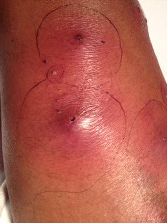 Consult a doctor for medical advice. CA-MRSA Skin Infections: An Ounce of Prevention is Worth a ...