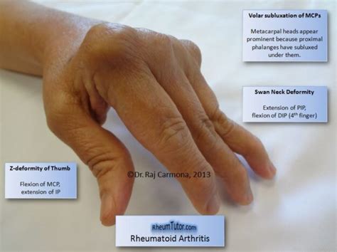 Rheumatoid Arthritis Rheumtutor