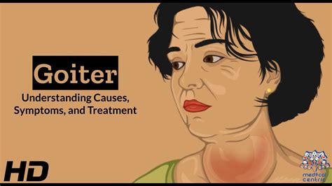 Thyroid Troubles Navigating Goiter Causes Symptoms And Treatment