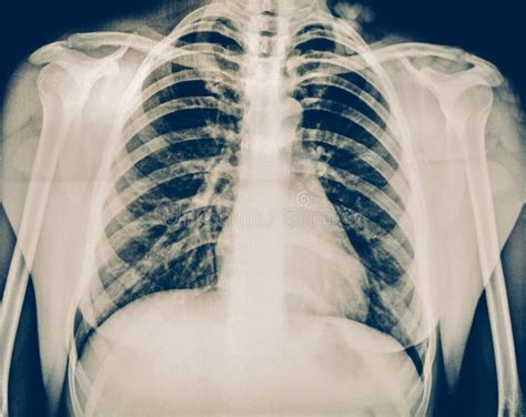 X Ray Of A Human Chest Or Lungs Radiography Shot Medical Technology