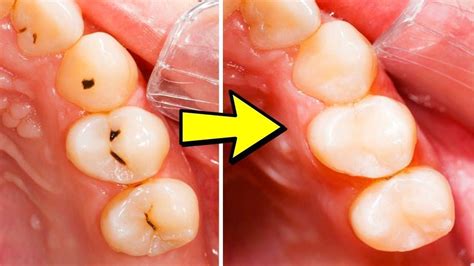 how to get rid of cavities the easy way doctor sutera explains