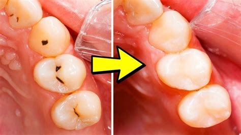 How long does it take to fill a surface cavity. How to Get Rid of Cavities the Easy Way | Doctor Sutera ...