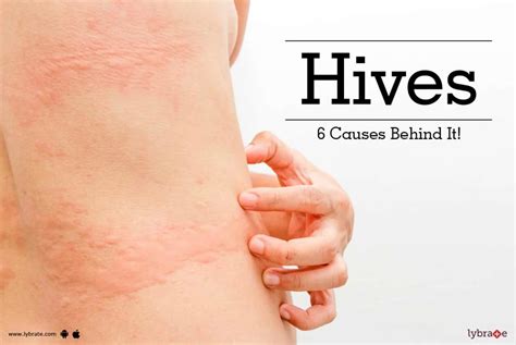 Hives Urticaria Causes Pictures Treatments And Symptoms