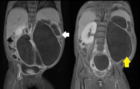 Mr Urography On Coronal T2wi Showing Hydronephrosis Of The Left Kidney