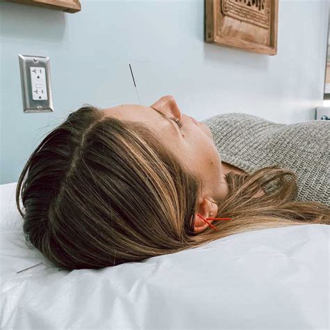 Acupuncture For Migraines In Brooklyn Ny Physio Logic Nyc
