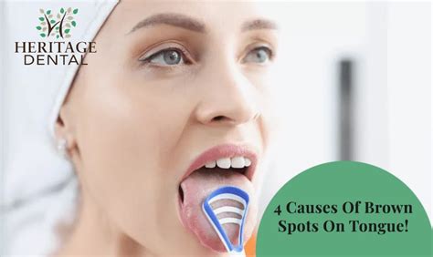 4 Causes Of Brown Spots On Tongue Know In This Blog