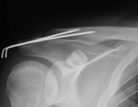 B The Acromioclavicular Joint Was Treated With Coracoclavicular