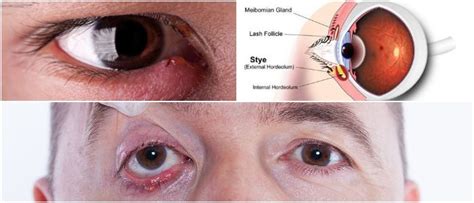 Stye Boil On Eyelid Causes Symptoms Diagnosis Treatment Hoool