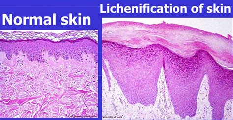 Lichenification Of Skin Causes And How To Get Rid Of Lichenification