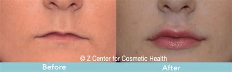 Considering Lip Fillers in Los Angeles? Read This First ...