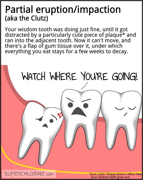 Pin On Wisdom Teeth