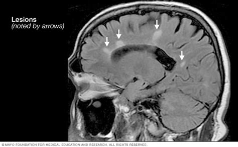 We will discuss the following subjects Multiple sclerosis - Diagnosis and treatment - Mayo Clinic