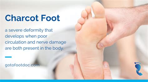 Charcot Foot Is A Very Serious Medical Complication That Is “an Amputation Waiting To Happen