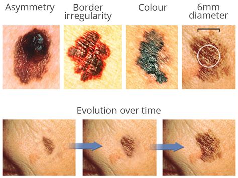 Toowong Skin Cancer Early Diagnosis