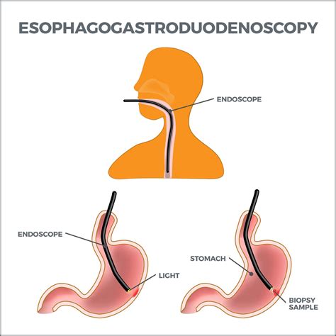 Upper Gi Endoscopy Gastro Md