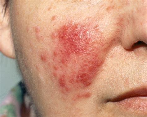 Skin Rash Causes Of Red Spots And Bumps With Pictures Allure