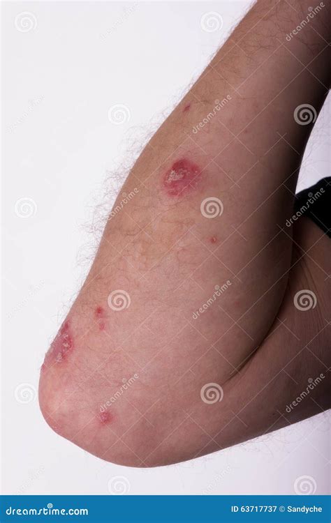 Men S Hand Diseased Psoriasis Elbow Stock Image Image Of Drop