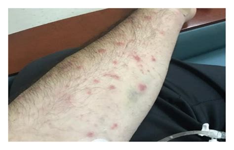 Skin Lesions Papular Maculopapular And Urticaria Like Rash