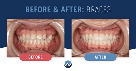 Before And After Braces See The Amazing Results Yourself • Woodhill