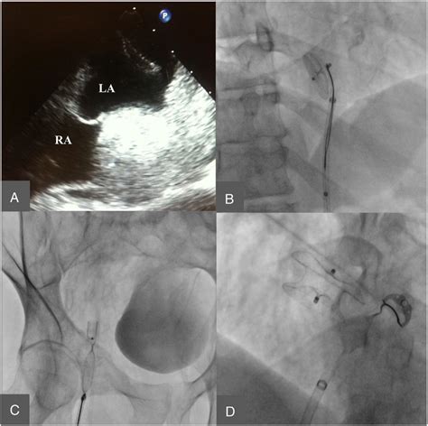 Cribriform Patent Foramen Ovale Occluder Embolization And Extraction