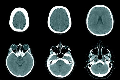 Normal Head On Ct Scans Stock Photo Download Image Now People
