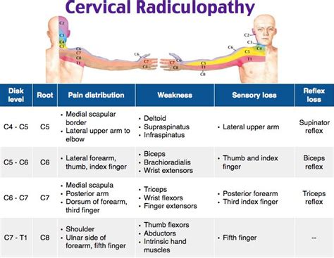 Cervical Radiculopathy In 2021 Cervical Radiculopathy Radiculopathy