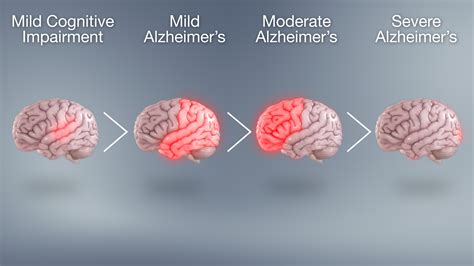 progression of alzheimer s disease through different stages