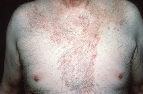 Not All Round Rashes Are Ringworm A Differential Diagnosis Of 2022