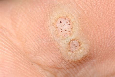Feet Plantar Warts Skin Disease Dermatology Stock Image Image Of