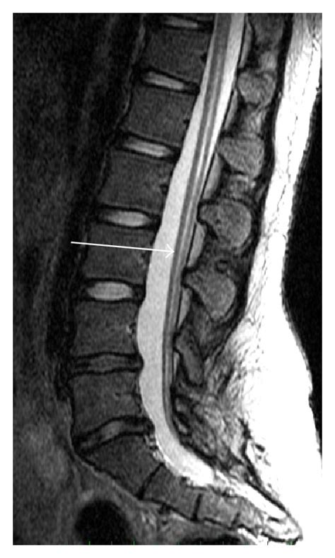 Sagittal T2 Weighted Magnetic Resonance Imaging Showed A Tethering Cord Download Scientific