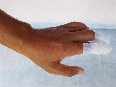 Cut Off Finger First Aid Treatment And Recovery