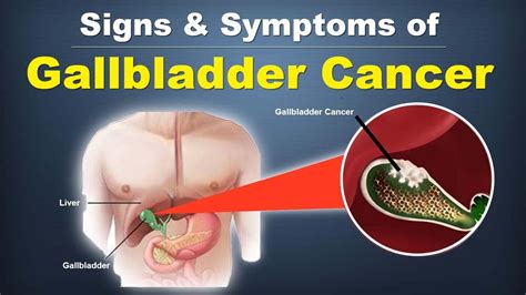 Gallbladder Cancer Symptoms Causes Treatment Doctor Medicine The Best