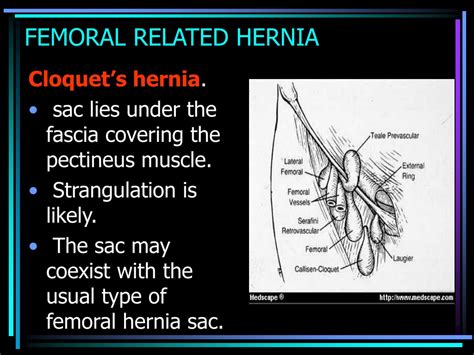 Ppt Femoral Hernia And Sliding Hernia Powerpoint Presentation Id9423392