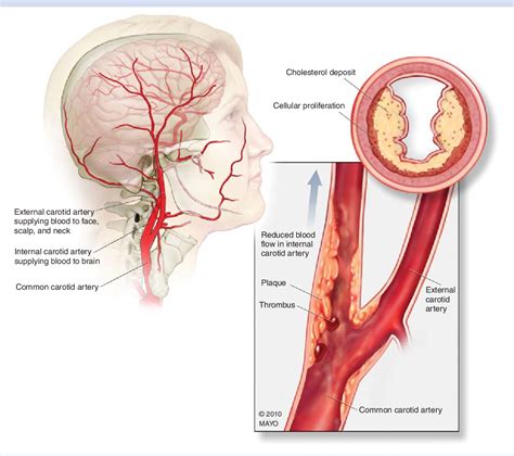 Figure 1 From Carotid Artery Disease Stenting Vs Endarterectomy