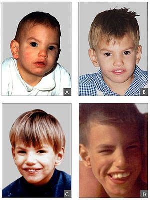 Cdc is committed to continuing to provide essential data on asd, search for factors that put children at risk for asd and possible causes, and develop resources that help identify children with asd as early as possible. Katzenschrei-Syndrom