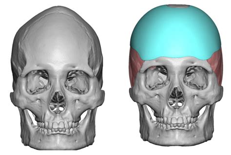 Custom Skull Implant For Sagittal Crest Skull Deformity Design Front