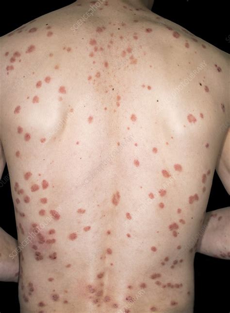 Guttate Psoriasis Stock Image C0180321 Science Photo Library
