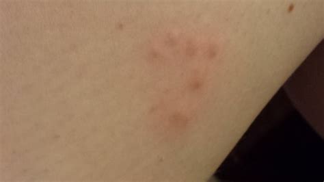 Small Itchy Cluster Bumps On Skin Images And Photos F